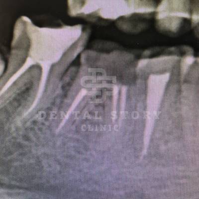 Апикальная гранулема 46 зуба, фото 1
