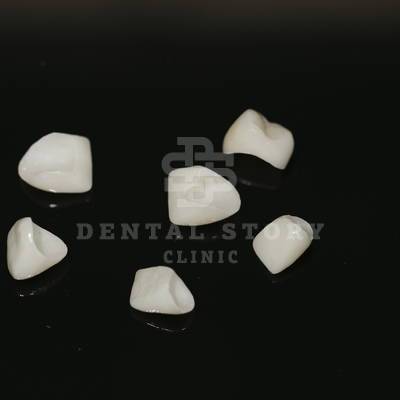 Безметалловые коронки устанавливаемые в Dental Story.