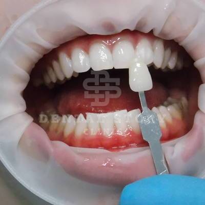Отбеливание зубов. Стоматология Dental Story. Часть 3