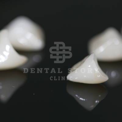 Безметалловые коронки в стоматологии Dental Story.