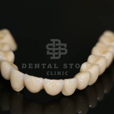 Безметалловый мостовидный протез с опорой на импланты в Dental Story.