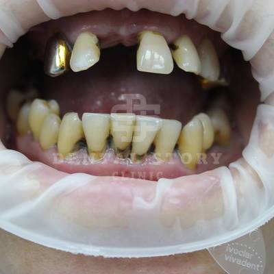 Все на 4х имплантатах - примеры работ Dental Story. Вид до начала работы