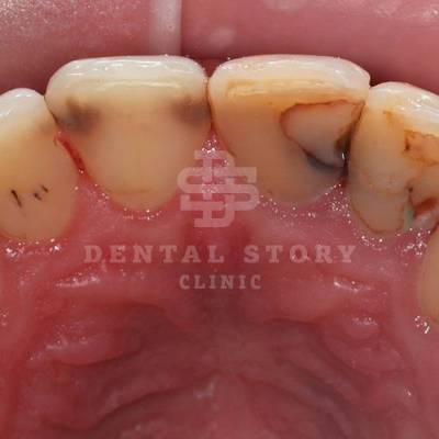 Фото после снятия зубных отложений. Пациент, 29 лет.