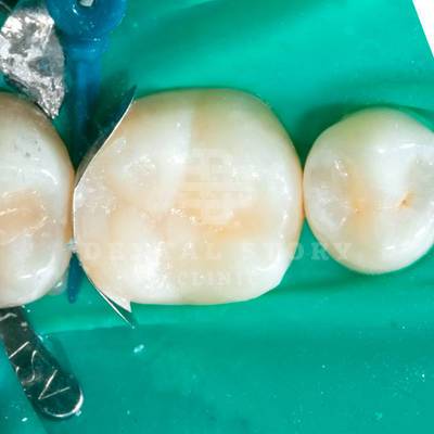 Восстановление стенки зуба с помощью матрицы