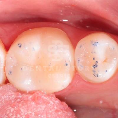 Коррекция пломбы по прикусу и контроль качества прилегание пломбы к зубу