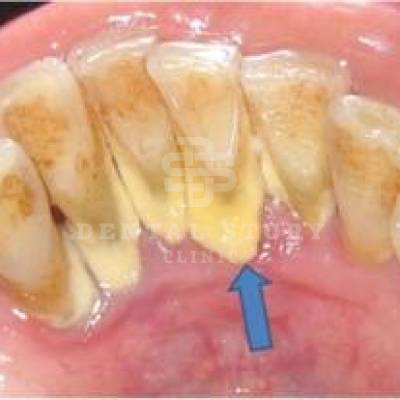 Минерализованные зубные отложения
