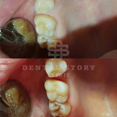 Лечение кариеса, восстановление 16 зуба, материал Filtek Ultimate. Реставрация жевательной поверхности, лечение кариеса в стоматологии Dental Story, фото до и после