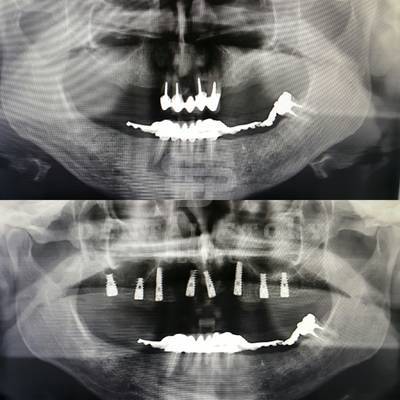 Одномоментная имплантация, Alfa Bio в стоматологии Dental Story