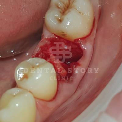 Зуб атравматично удален в стоматологии Dental Story, фото 3