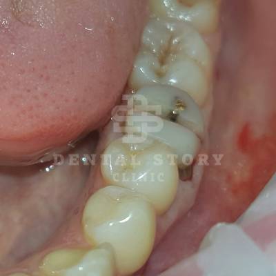 Зуб фрагментируется, фото 2, в стоматологии Dental Story