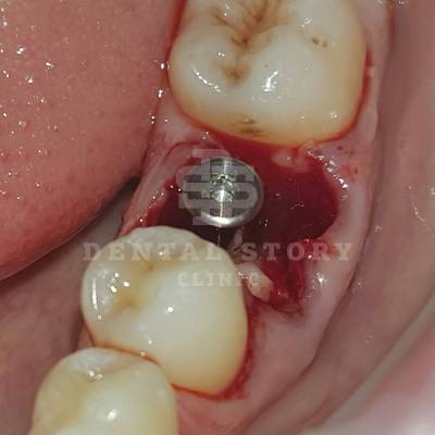 Установлен имплантат Nobel Select PMC в стоматологии Dental Story, фото 4