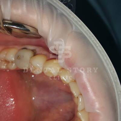 36 зуб. Диагноз - гранулематозный периодонтит осложненный кариесом цемента. Рекомендовано удаление в стоматологии Dental Story, фото 1