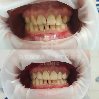 Эстетический дефект, отсутствуют 13, 23 зубы, материал EMax, 14, 11, 21, 24 зубы витальны (вид до и после)