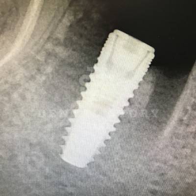 46 зуб удален, в межкорневую перегородку установлен имплантат, фото 2