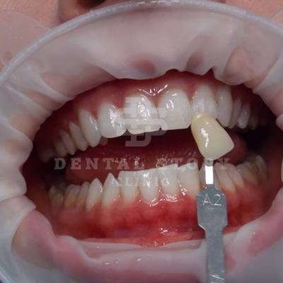 Отбеливание зубов до и после. Стоматология Dental Story. Часть 4