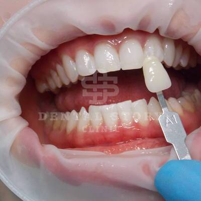 Отбеливание зубов. Стоматология Dental Story. Часть 2