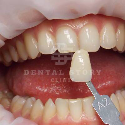 До отбеливания зубов. Стоматология Dental Story. Часть 1