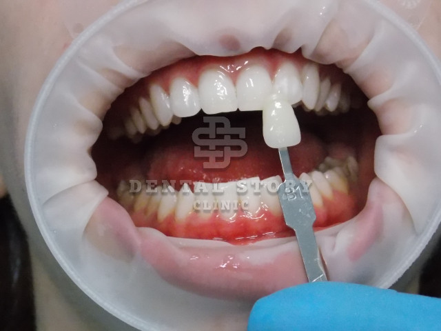 Отбеливание зубов. Стоматология Dental Story. Часть 3