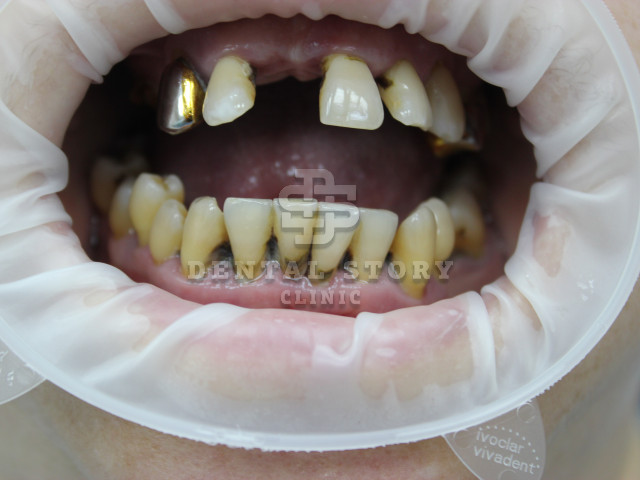 Все на 4х имплантатах - примеры работ Dental Story. Вид до начала работы