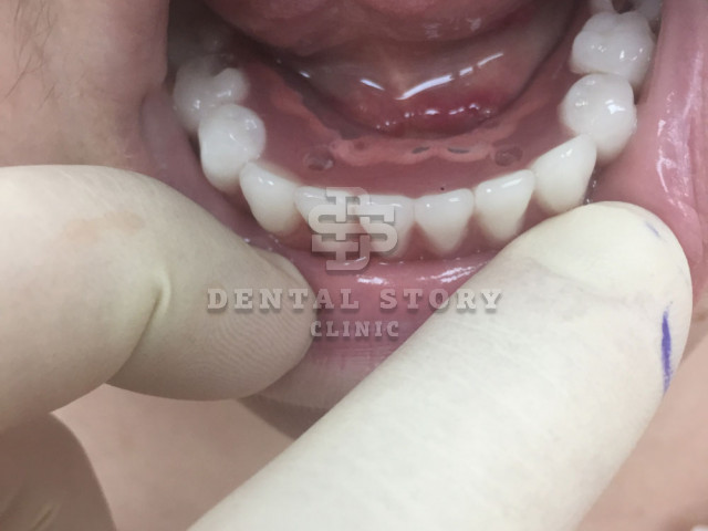 Все на 4х имплантатах - примеры работ Dental Story. Постановка на 2й день после имплантации