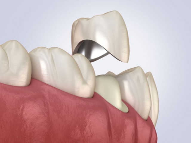 Металлокерамические коронки
