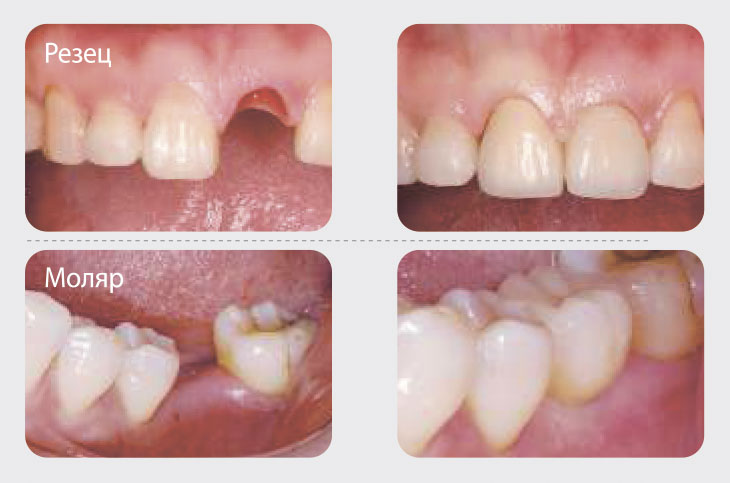 Примеры до и после имплантации Osstem. Отсутствие 1 зуба - до и после