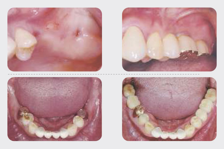 Примеры до и после имплантации Osstem. Отсутствие нескольких зубов - до и после
