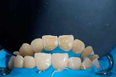Шаг 2. Удаление пораженных твердых тканей зубов кариесом.