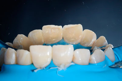 Шаг 3. Восстановление зубов композитными реставрациями. Полирование.