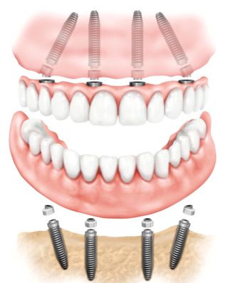 Имплантация зубов по методике все на четырех