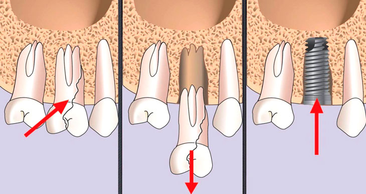 Имплантация после удаления зуба