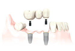 Имплантация Nobel. Мостовидные протезы. Цементная фиксация на зубах; цементная или винтовая фиксация на имплантатах