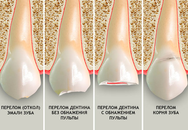 Травматическое повреждение зуба