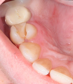 Зуб восстановленный пломбой треснул
